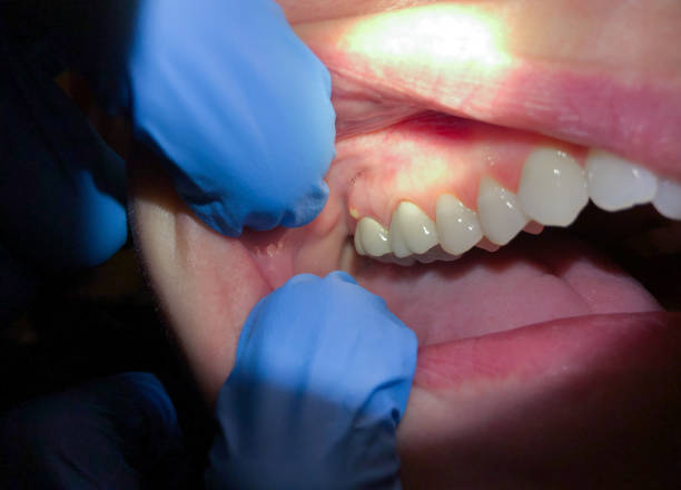 Best Emergency Treatment for Dental Infections or Abscesses in View Park Windsor Hills, CA
